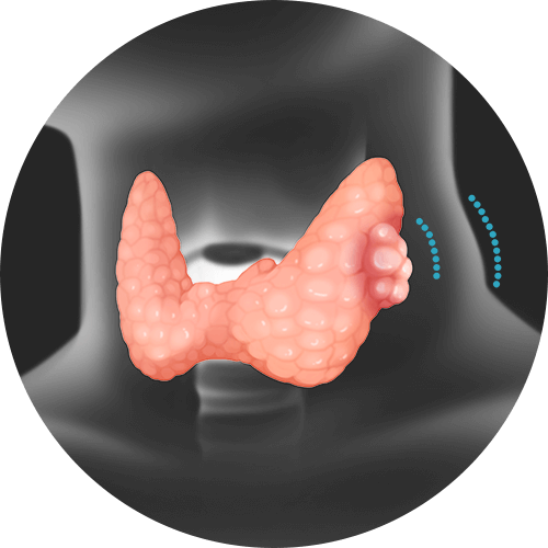 우리 몸에 갑상선에 암이 생긴 모습을 표현한 일러스트